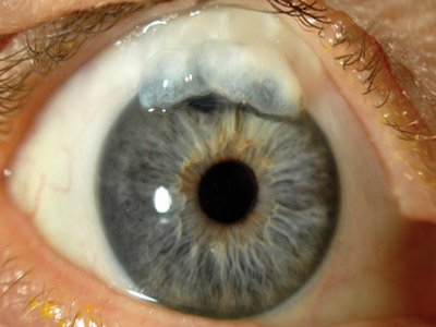 Glaucoma