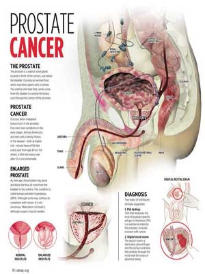 Prostate-Copy