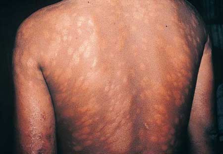 leprosy
