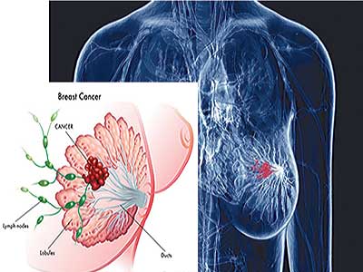 Breast-cancer-scan