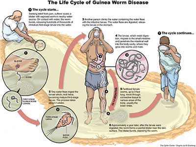 Guinea-worm