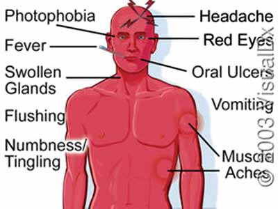 Symptoms of Lassa fever PHOTOS CREDIT: google.com/search