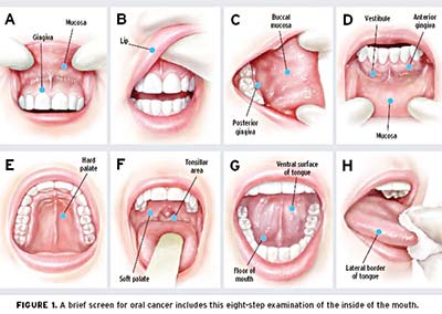 oral-cancer-exam