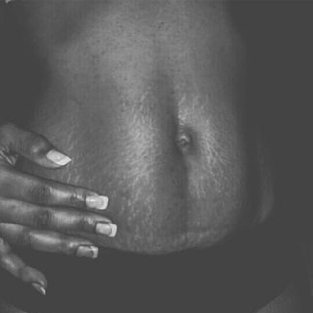 The Truth Behind Stretch Marks | The Guardian Nigeria News - Nigeria