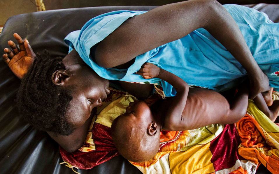 FILES-SSUDAN-HEALTH-MALNUTRITION-FAMINE