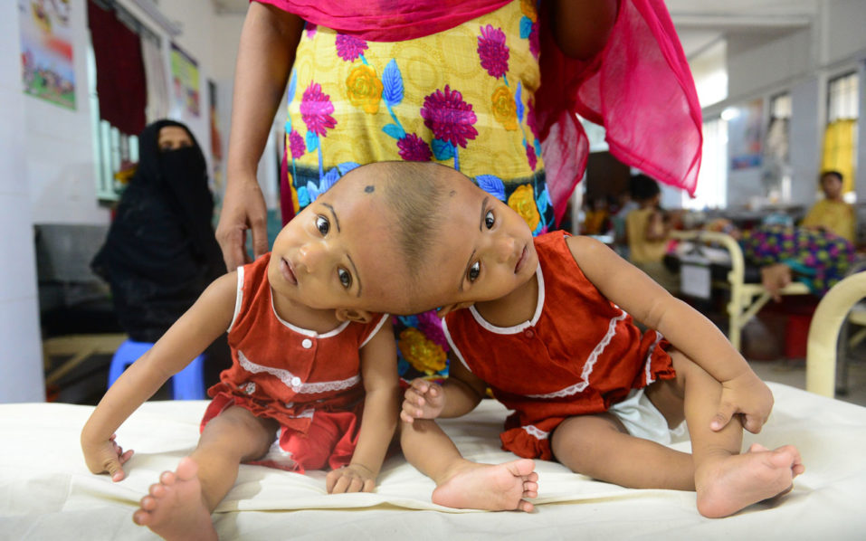 BANGLADESH-HEALTH-CONJOINED-TWINS