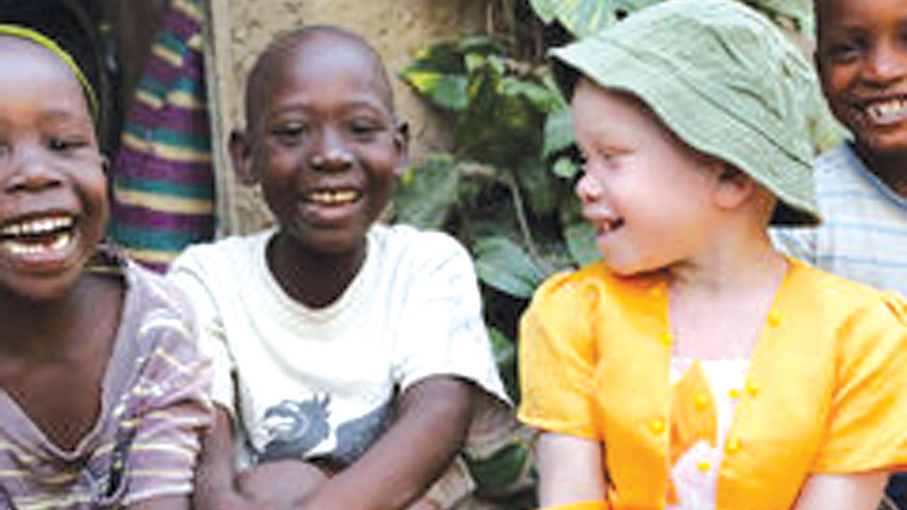 albinism