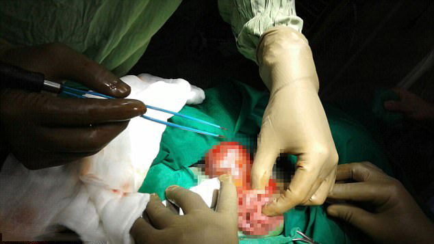 Baby born with twin