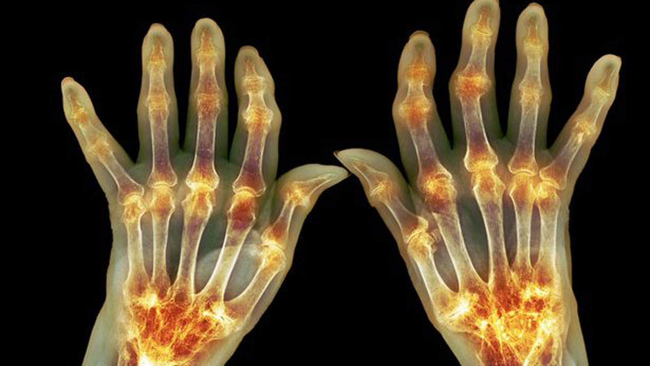 ARTHRITIS