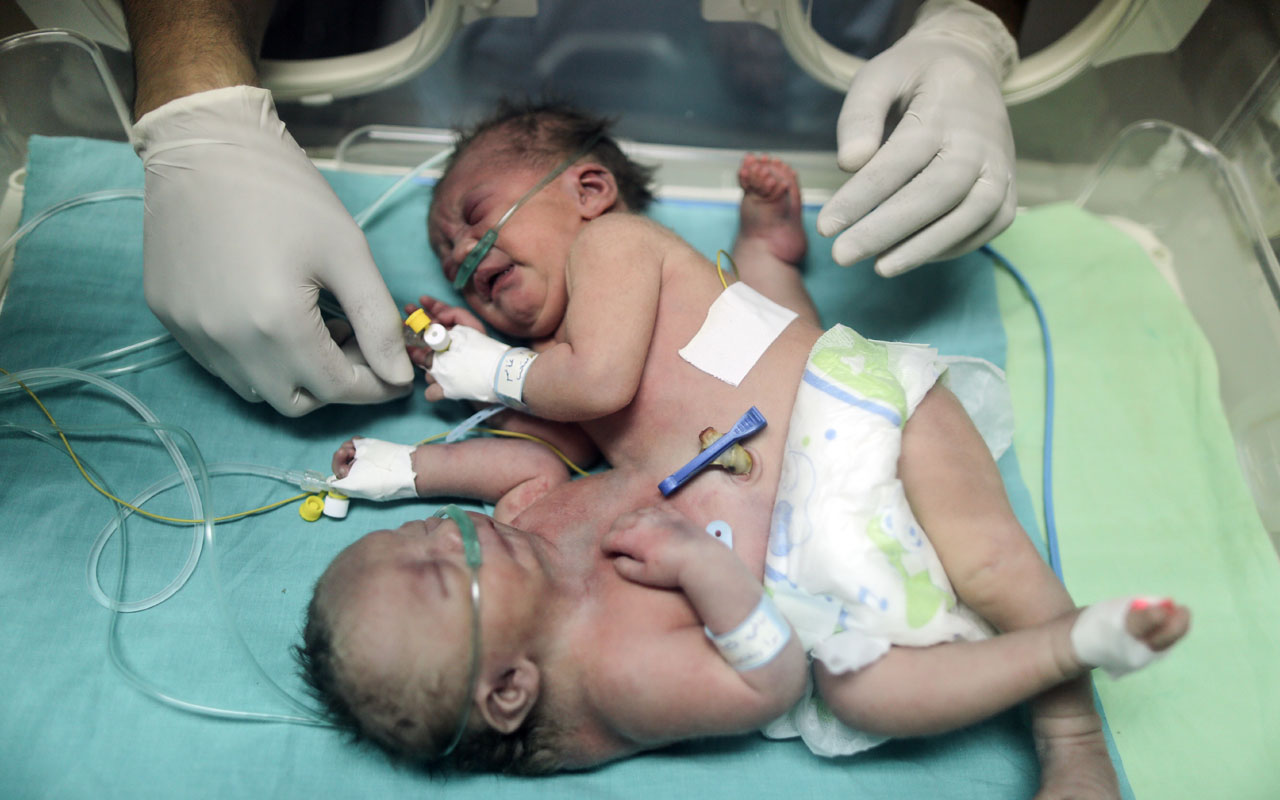 FILES-PALESTINIAN-ISRAEL-GAZA-MEDICINE