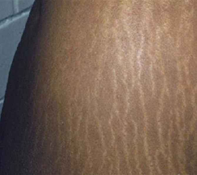 stretch-marks