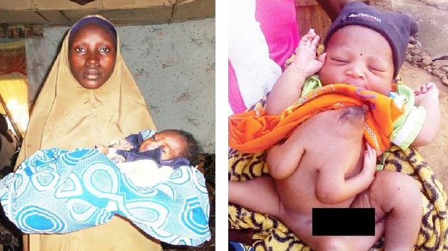 Baby_born_with_4_hand