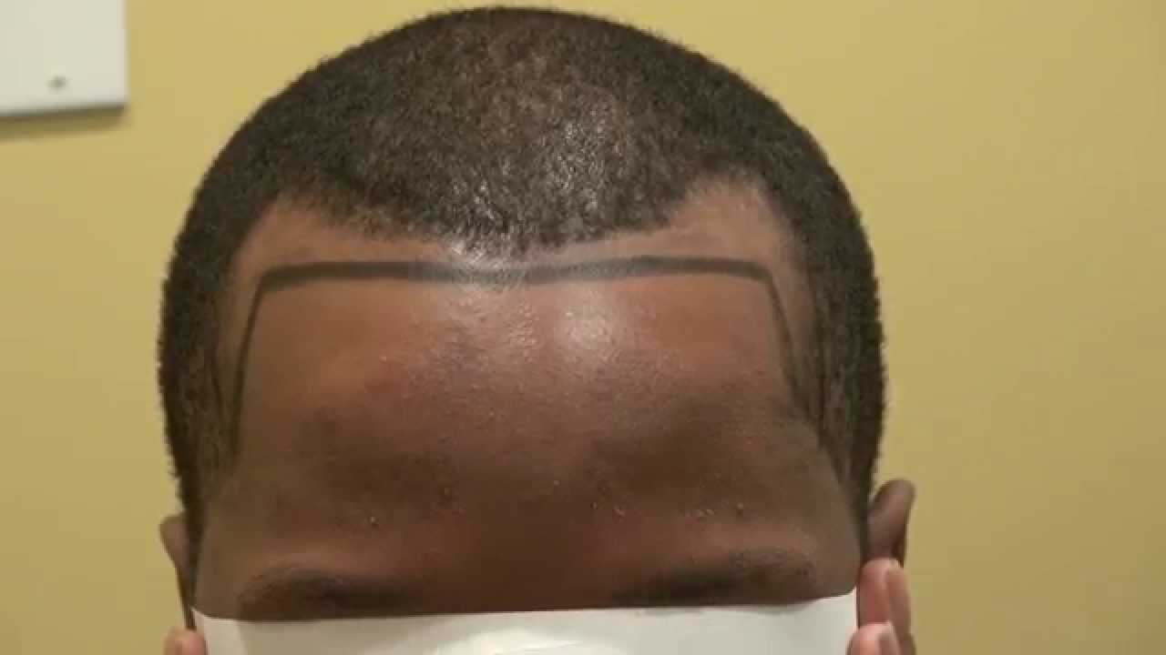 Black Man Receding Temple Hair Loss photo Youtube