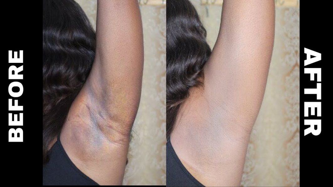 Black armpit