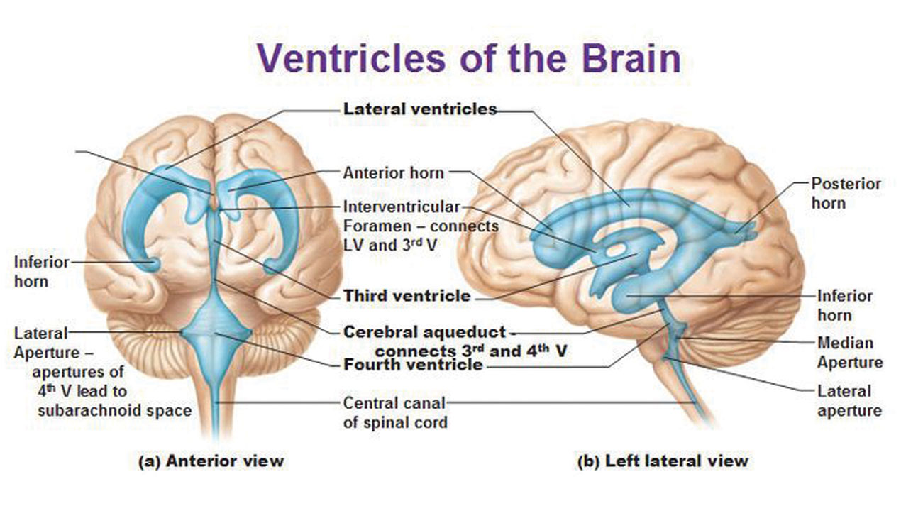hydrocephalus