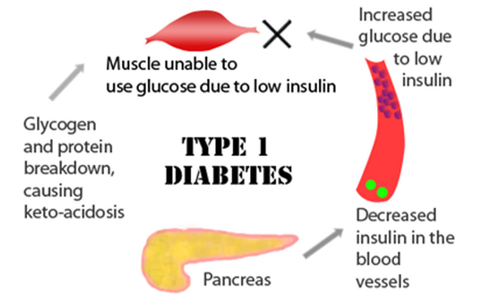 DIABETES-11-11-18