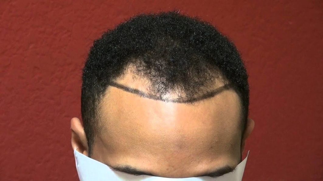 Balding Man, Photo. YouTube