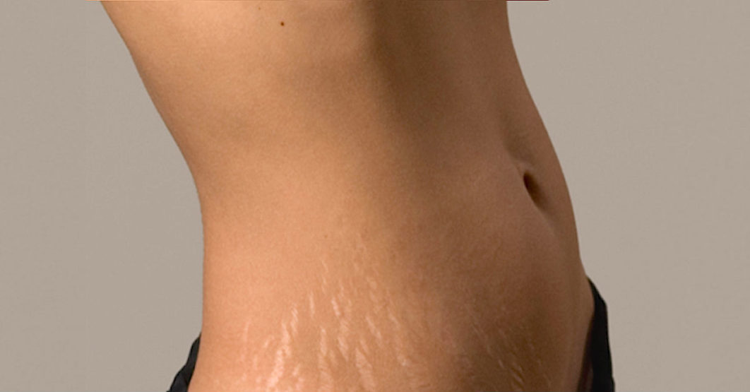 Stretch Marks on a lady’s stomach, Photo. Little Things
