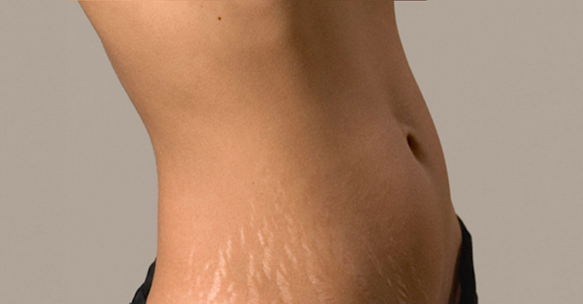 Stretch Marks on a lady’s stomach, Photo. Little Things
