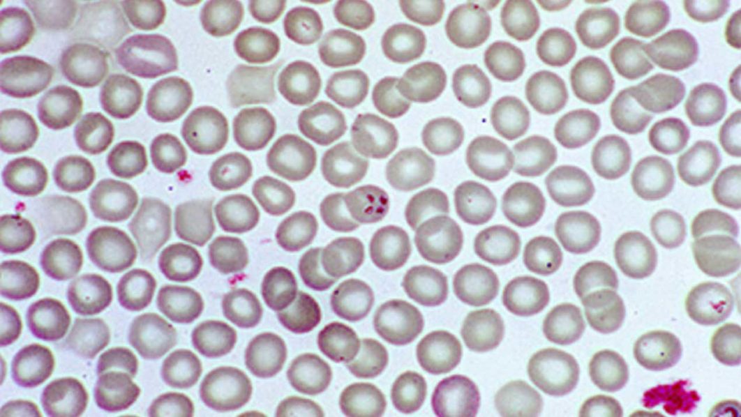 babesiosis