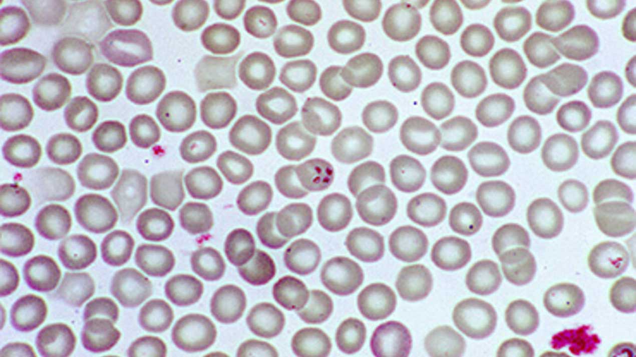 babesiosis