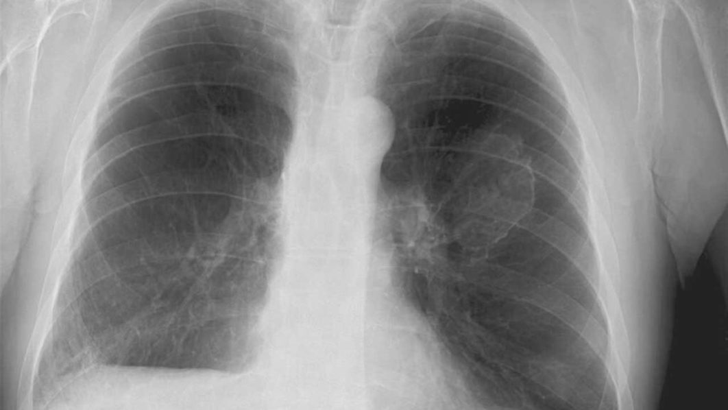 asbestosis
