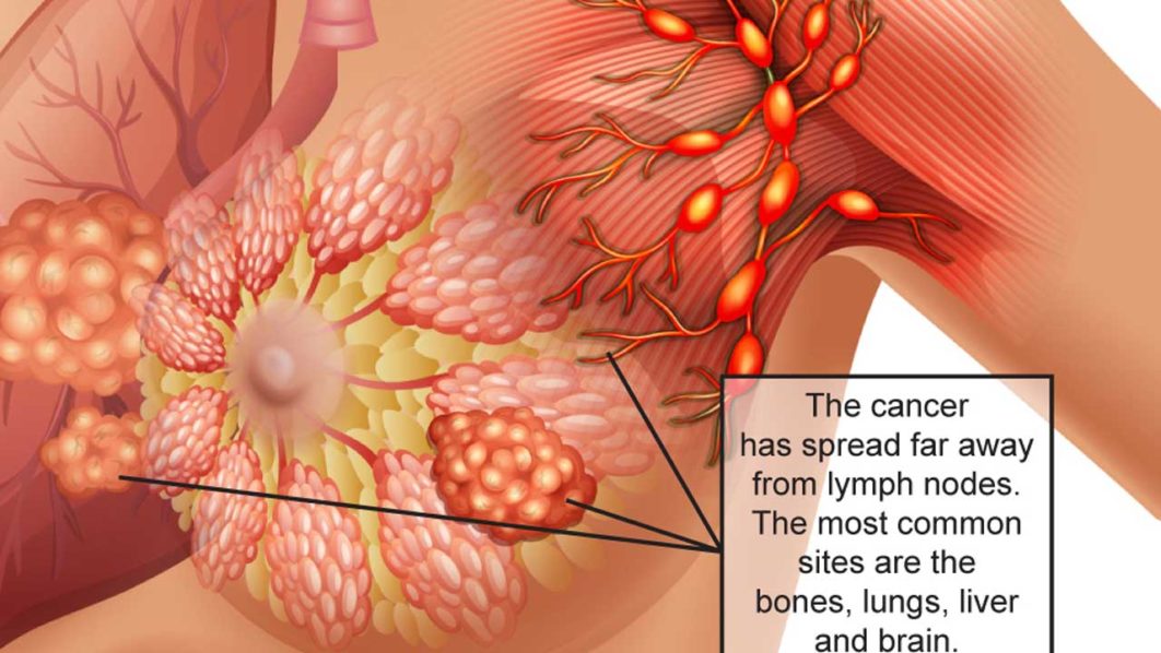 BREAST-CANCER