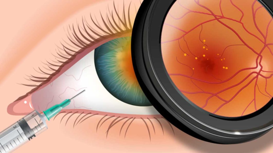 lucentis-avastin-1200×630.jpg