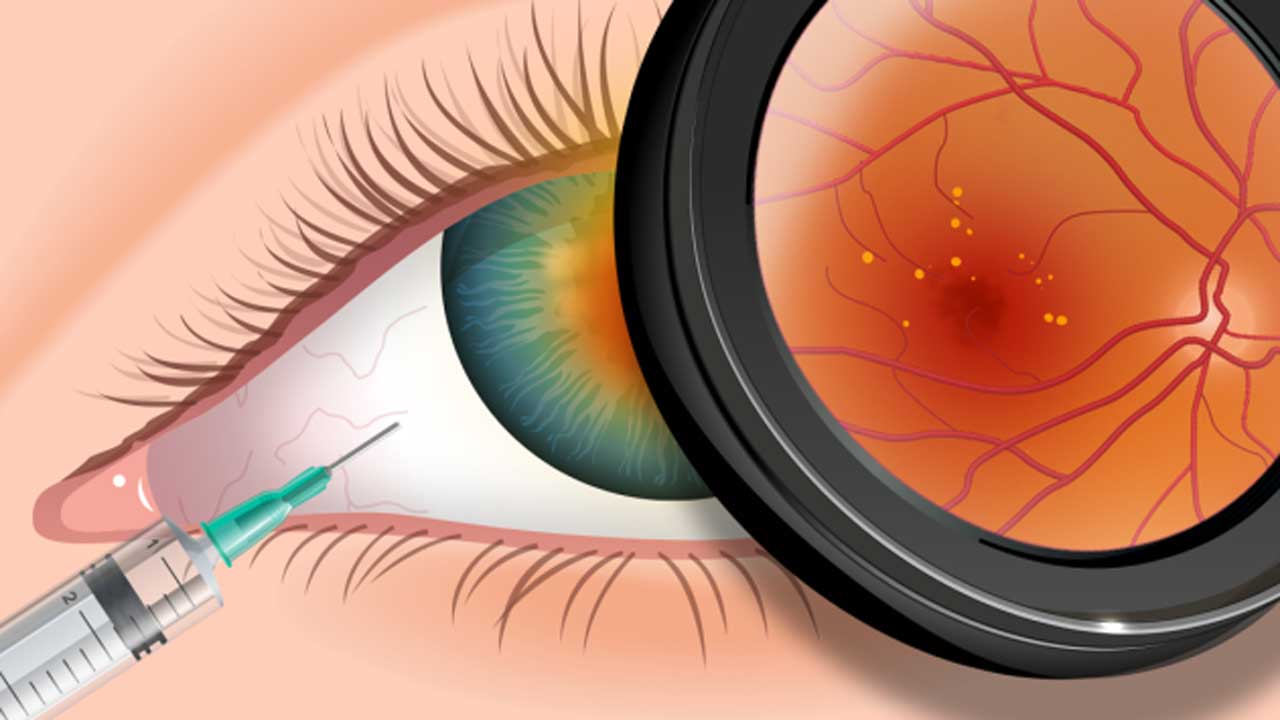 lucentis-avastin-1200×630.jpg