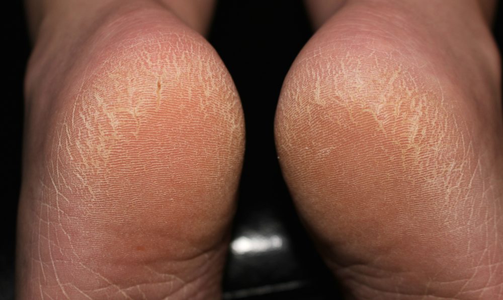 Cracked Heels, Photo. The Unextreme