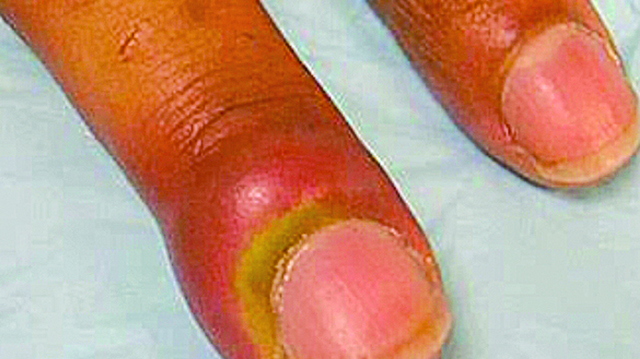 Acute Paronychia