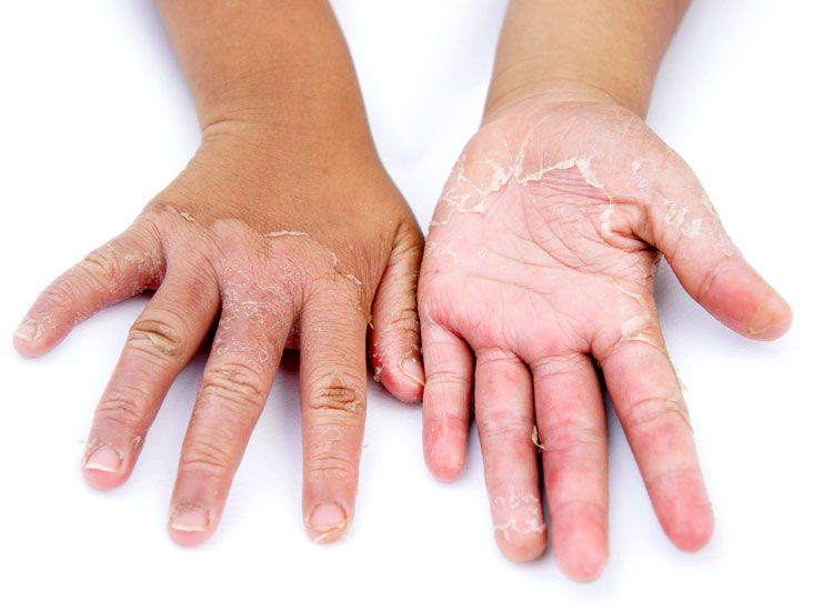 peeling skin