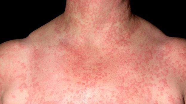 Aquagenic urticaria