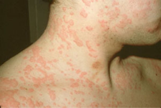 Aquagenic urticaria