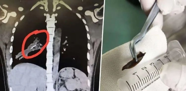 Bone in lung