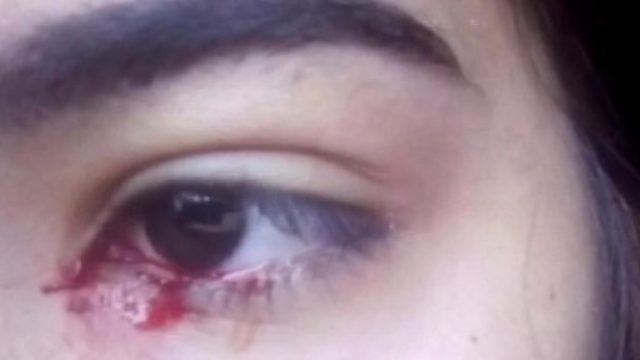 15-Year-Old Allegedly Cries Blood And Doctors Have No Idea Why