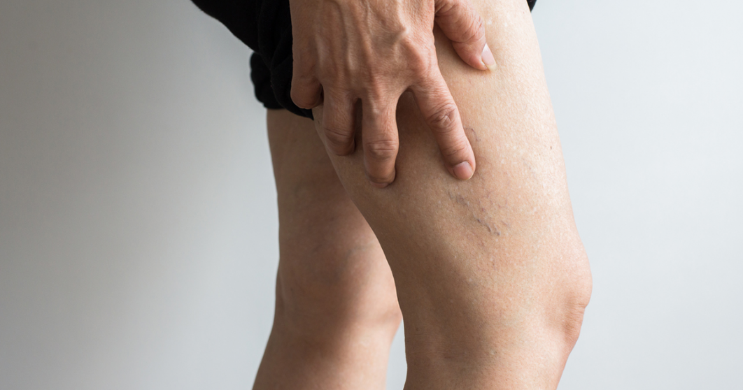 Deep-Vein-Thrombosis