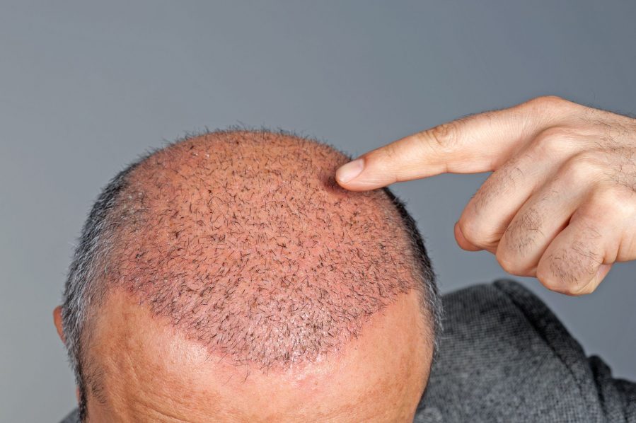 Hair Transplant – Image – Men’s Health