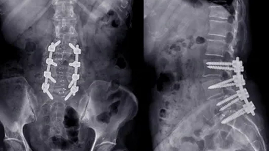 spinal cord implant