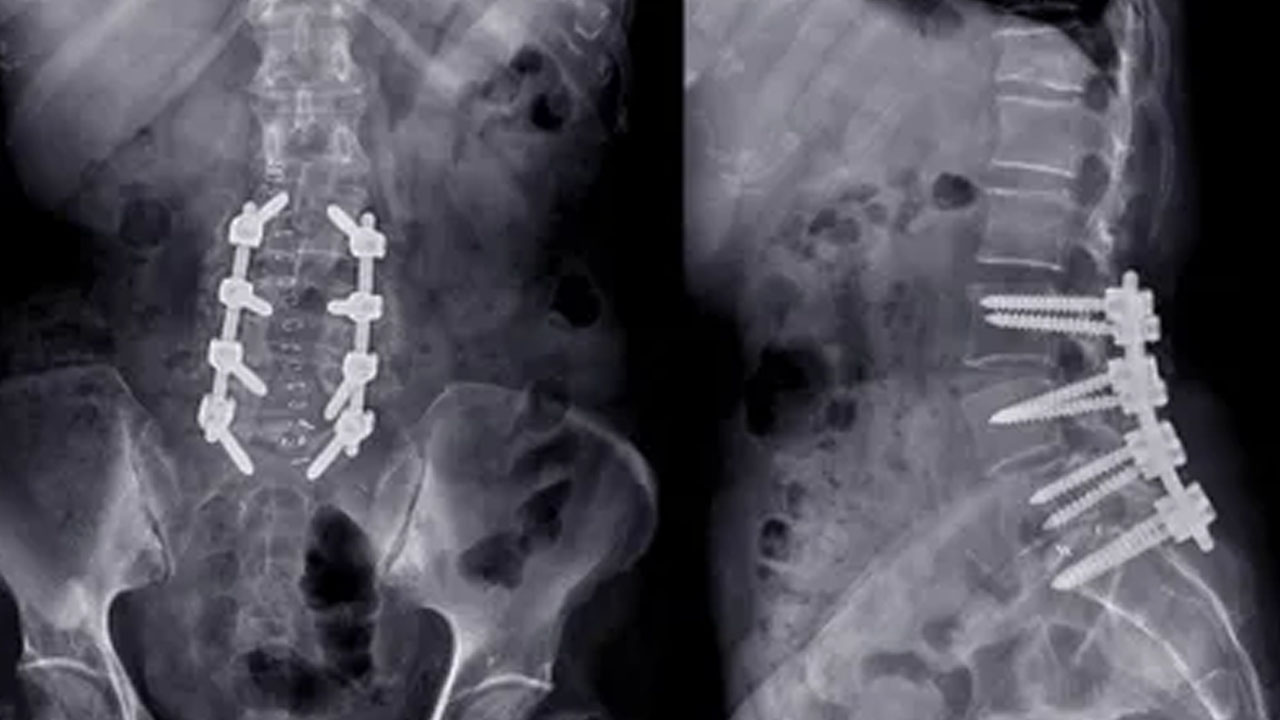 spinal cord implant