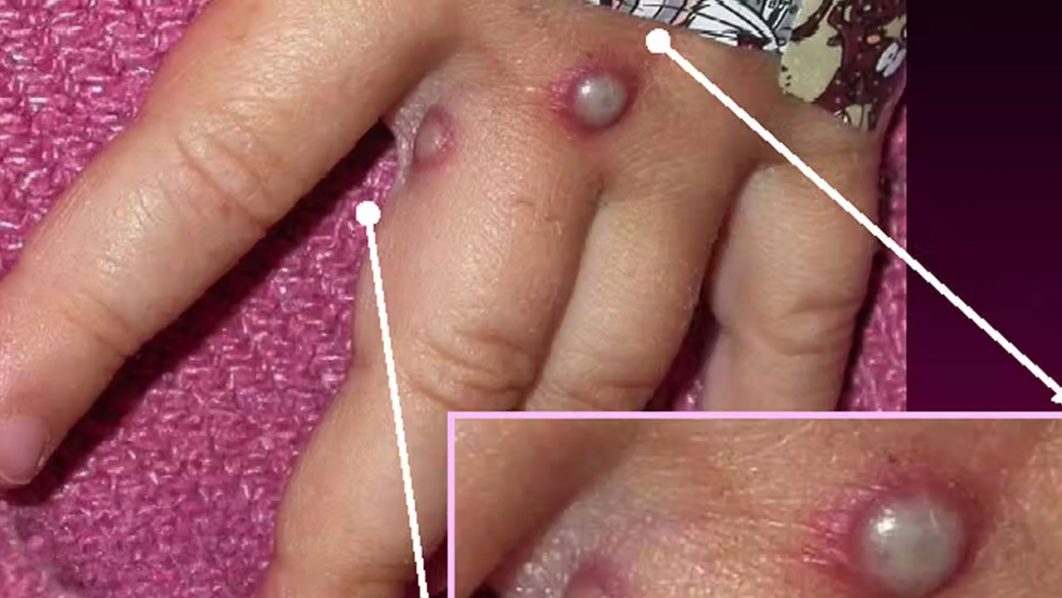 monkeypox