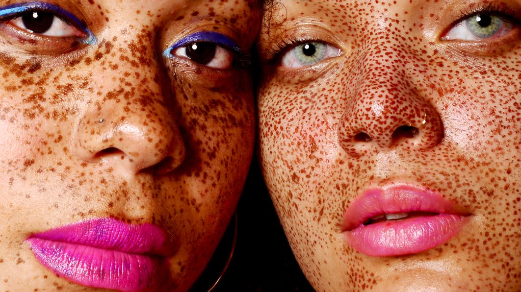 Hyperpigmentation Causes and Natural Remedies for Correction