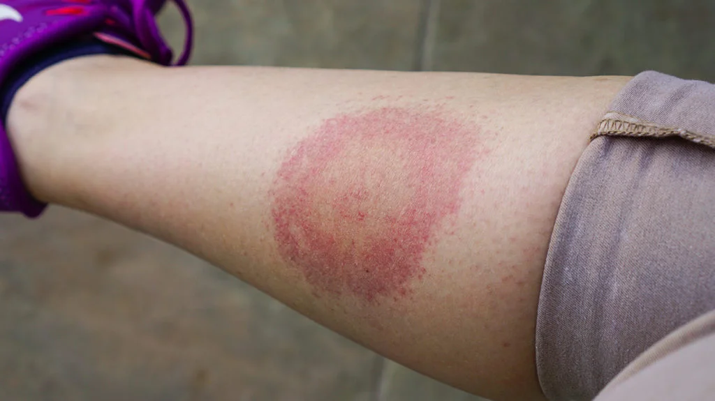 lyme disease