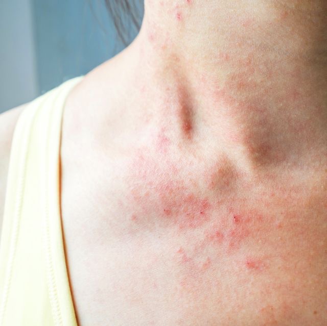 Sotthing Heat Rash Beat The Heat With Flawless Skin