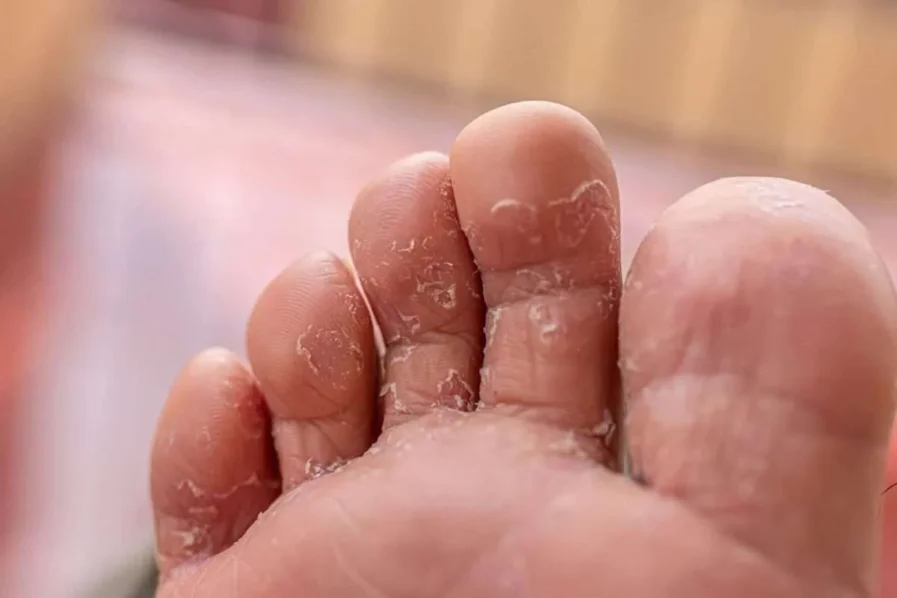 Athlete’s foot