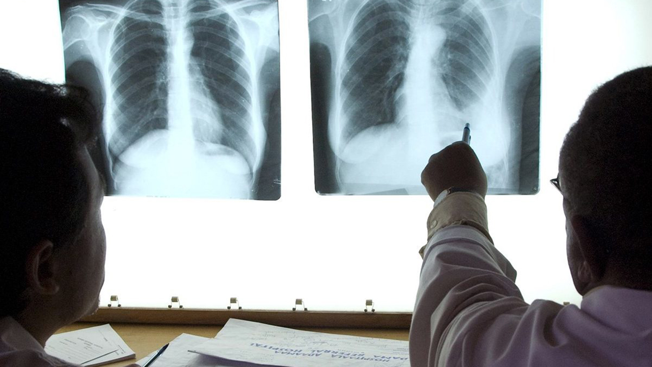 NCoS debunks TB outbreak report in custodial facilities