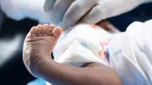 Newborn with club foot