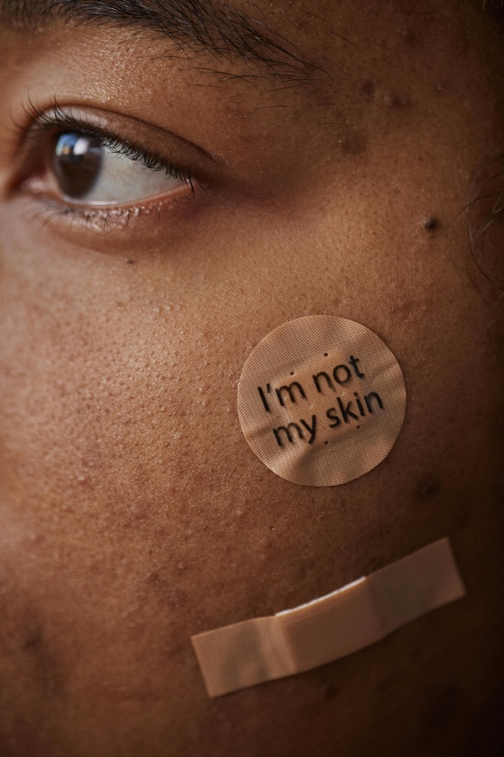 A girl with a pimple patch on her face