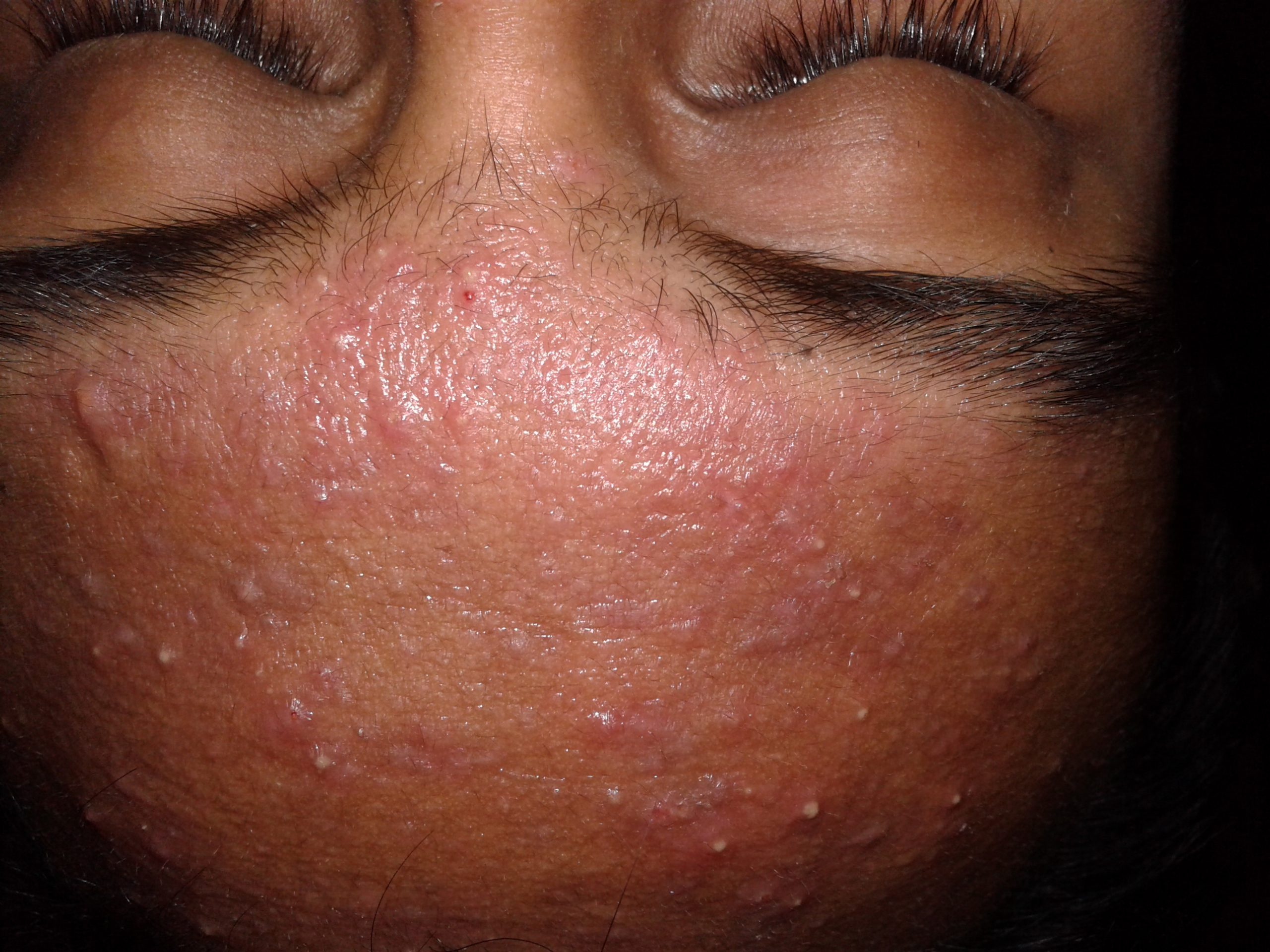 Acne. Photo by Freepik