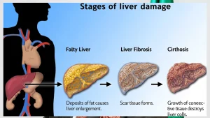 Fatty Liver Disease